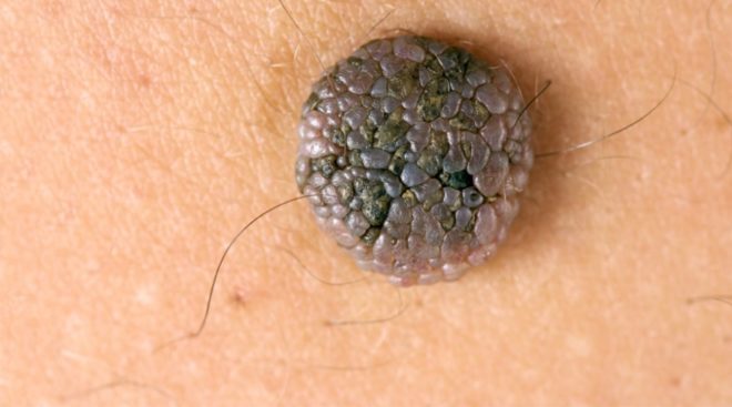 what-is-moles-causes-symptoms-and-homeopathic-treatment