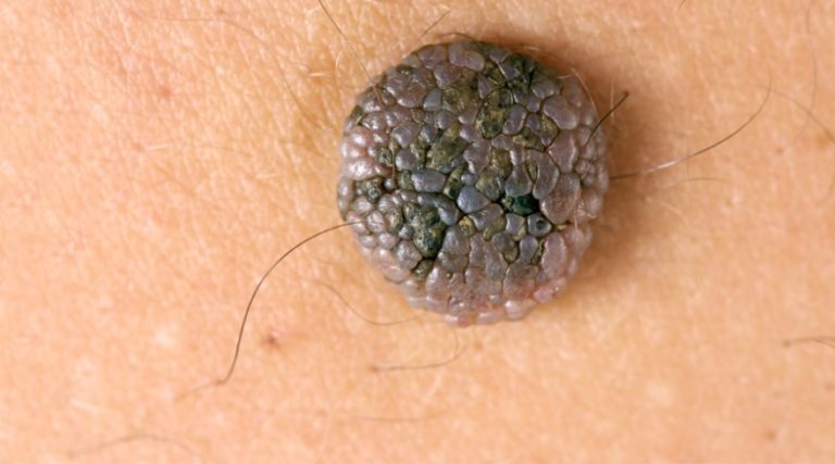 Blue moles in hair: Causes, treatment, and prevention - wide 5