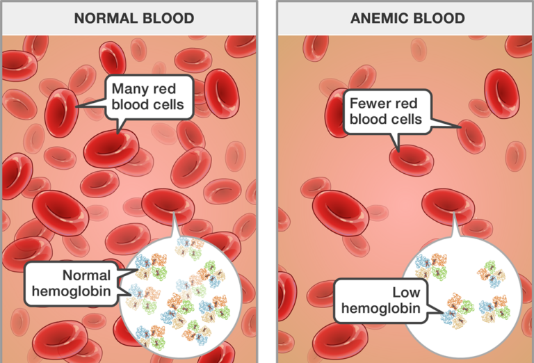 What is Anemia? Symptoms, Diagnosis & its Homeopathic Treatment