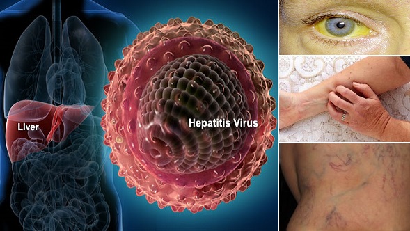 Hepatitis E-Symptoms-Causes-Treatment Homeopathic Treatment.jpg